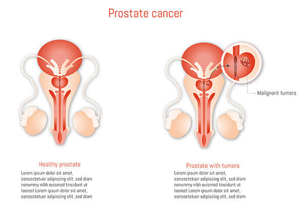 Former President Biden Diagnosed with Aggressive Prostate Cancer, Trump Extends Well Wishes